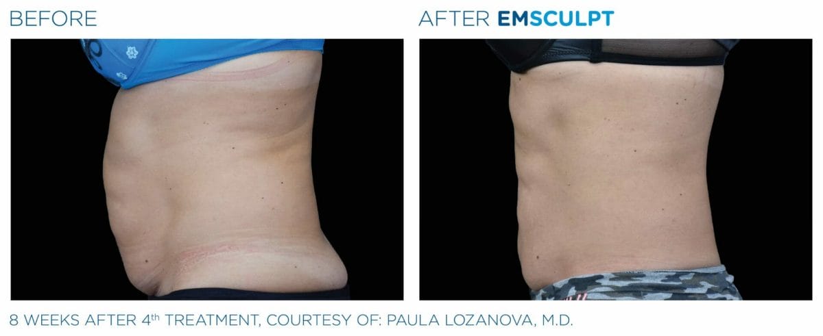 emsculpt before after photo chicago