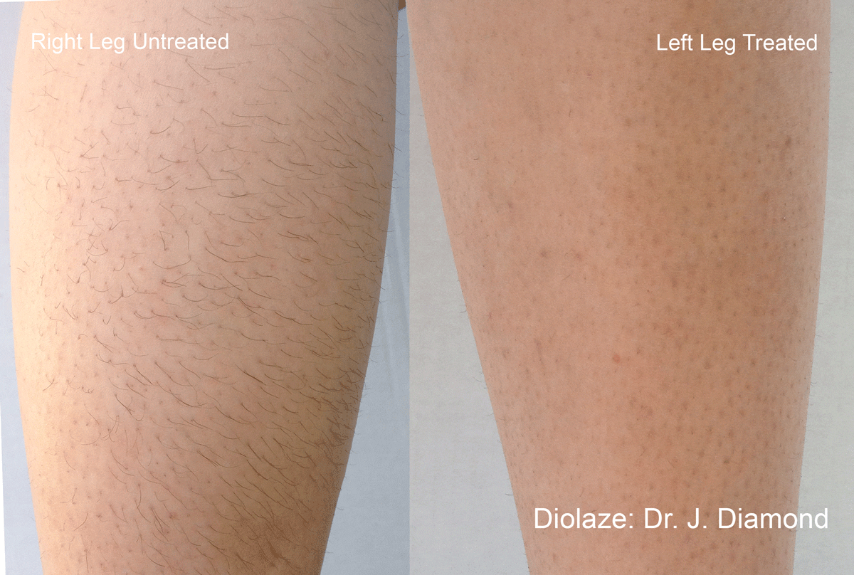 diolaze before after legs