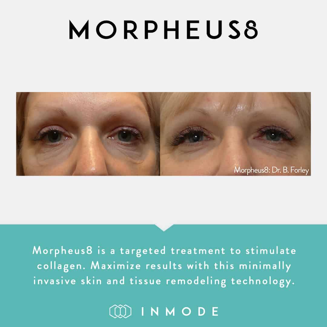 morpheus8 before after face