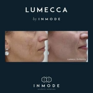 IPL Lumecca before and after chicago aesthetics med spa