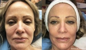 forma facial before after photo