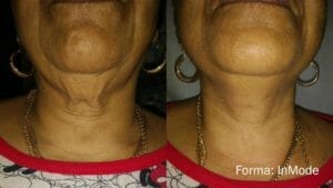 forma neck before after photo