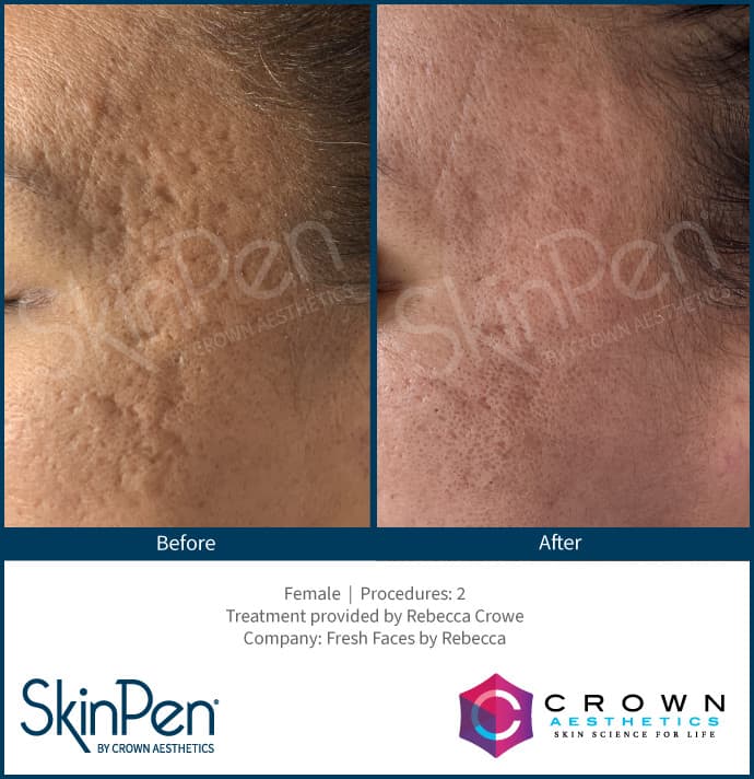 before and after microneedling