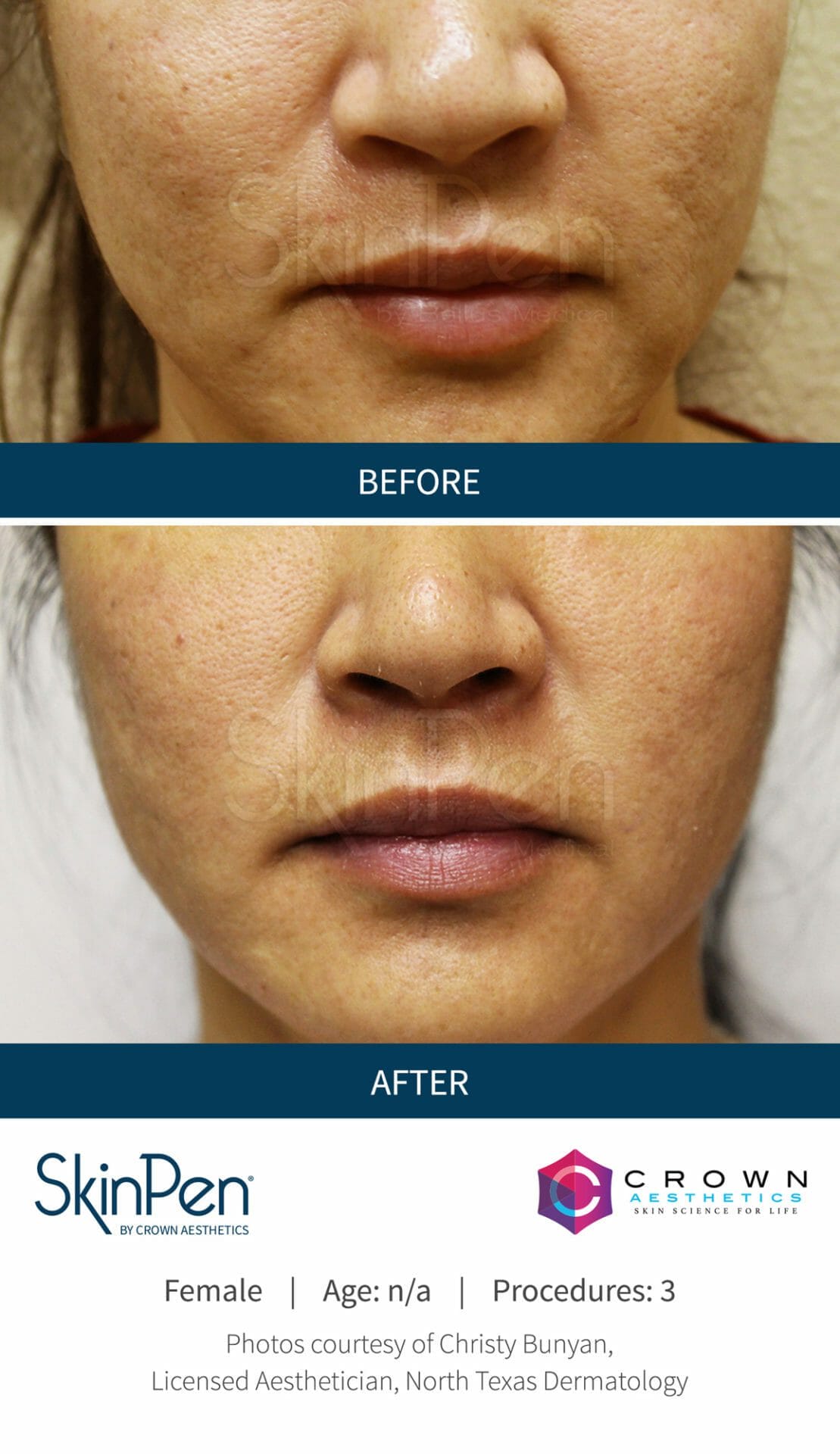 Before-After-Microneedling-Skinpen-Chicago (2)