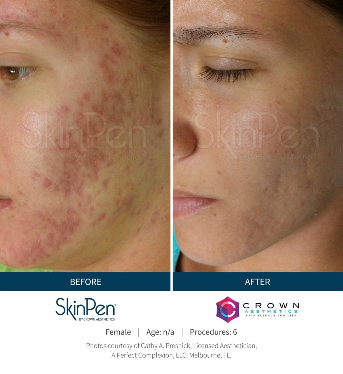 Before-After-Microneedling-Skinpen-Chicago (4)