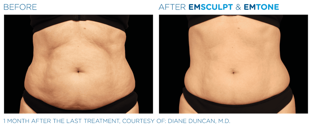 emsculpt chicago before and after