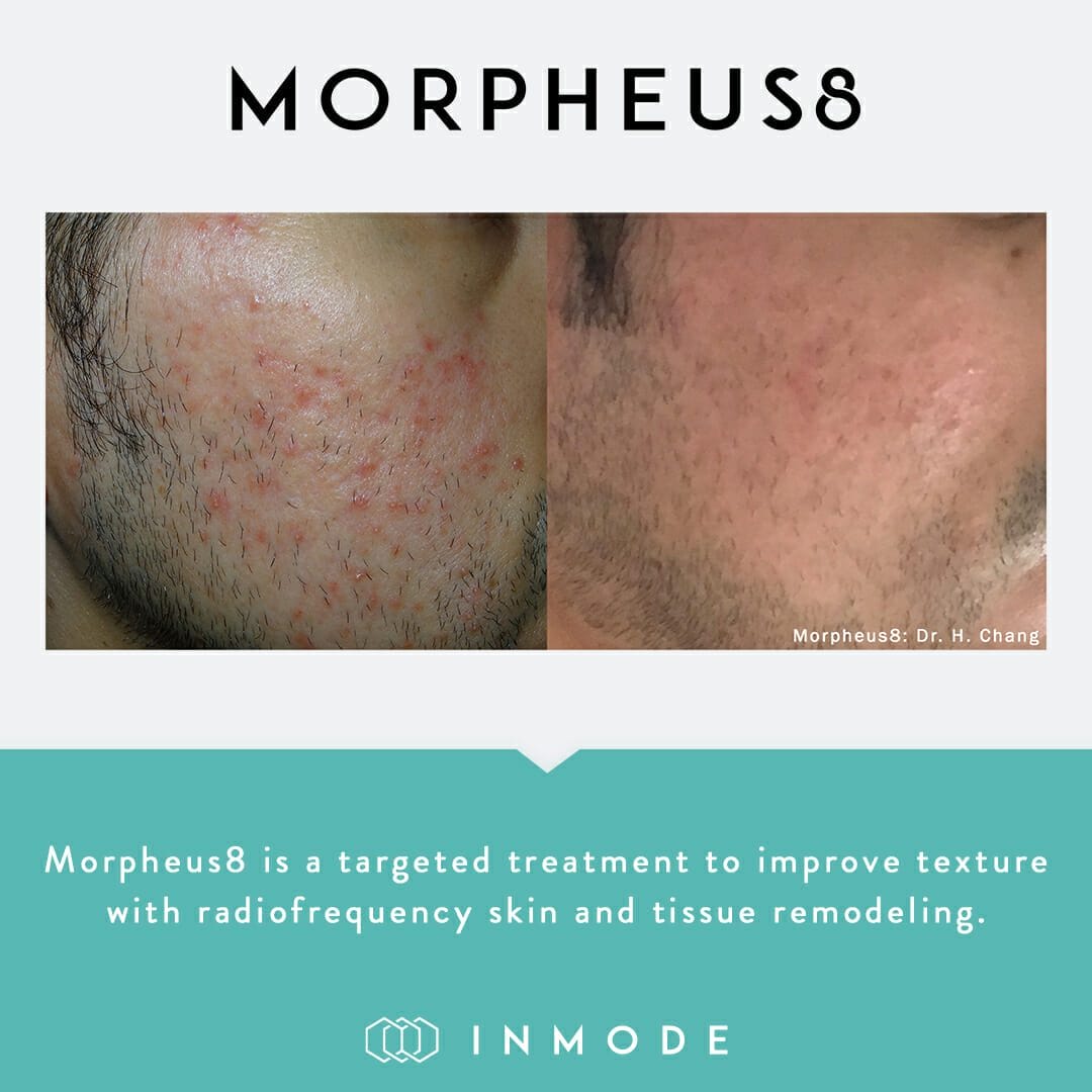 morpheus 8 acne treatment before after photo