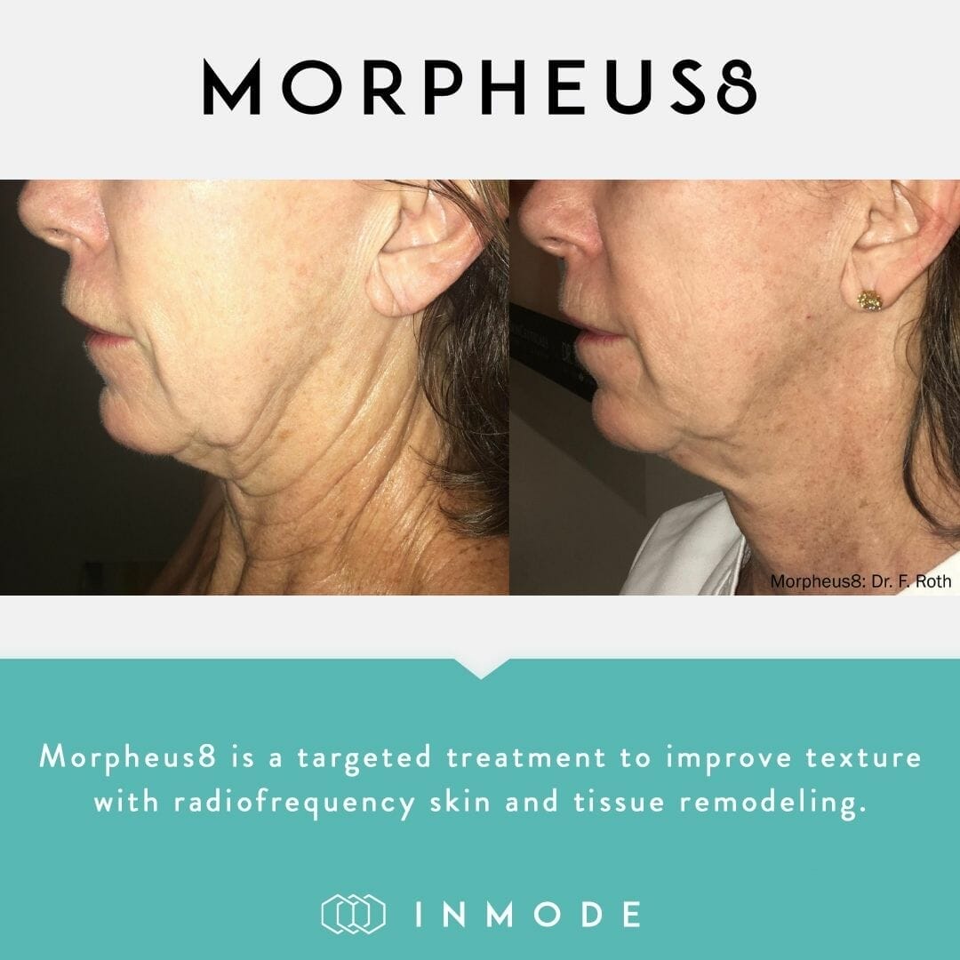 skin tightening treatment no surgery morpheus8