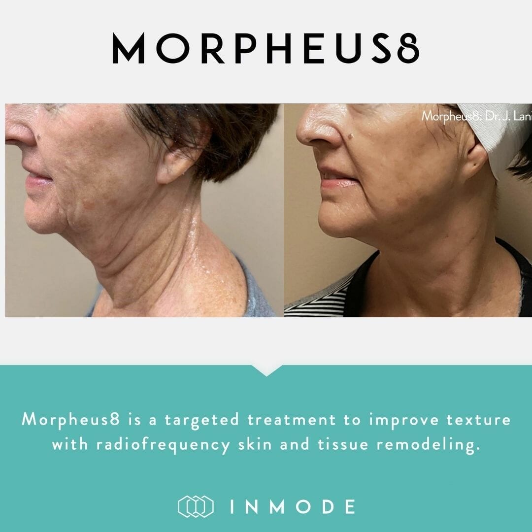 morpheus 8 before after photo neck