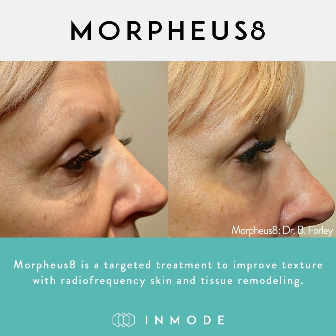 morpheus8 before after eyes
