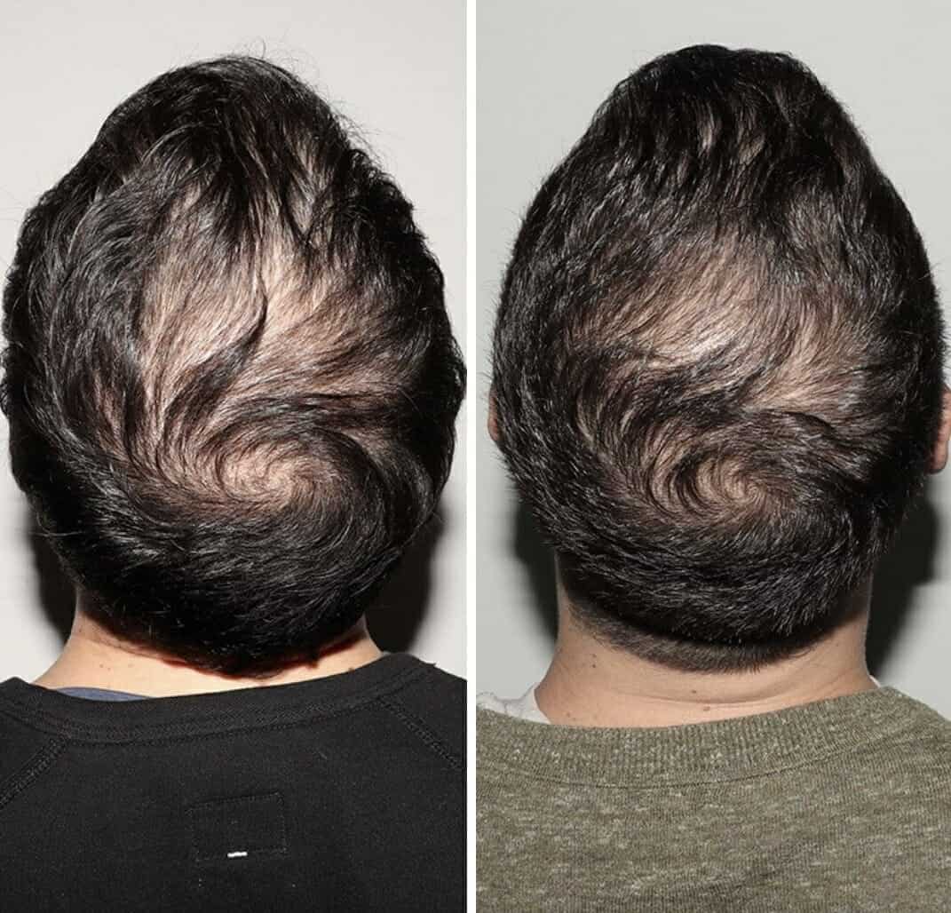 hair loss treatment in chicago