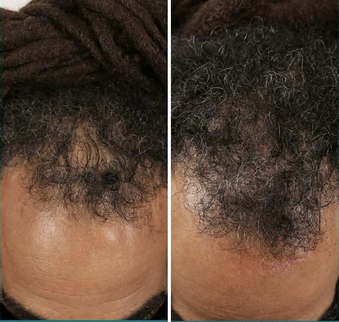 hair loss treatment for men chicago