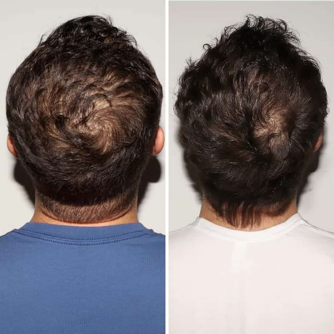 hair loss supplement for men