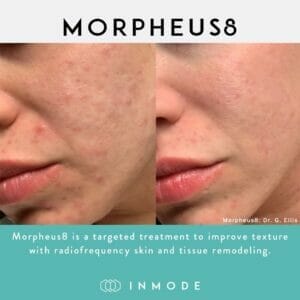 morpheus8 acne treatment